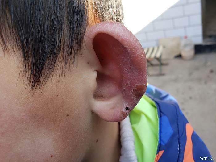 孩子冻伤的耳朵