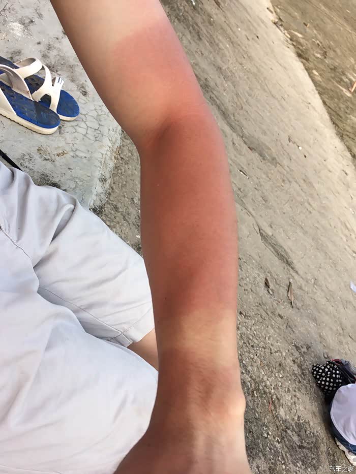 今天在西部沿海高速来回跑了三百多公里,左手就给阳光晒伤,这阳光也太