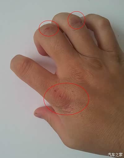 受伤的右手,2天2夜后就是这样.