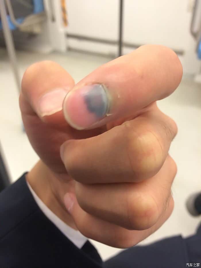 手被夹淤血了.疼死了