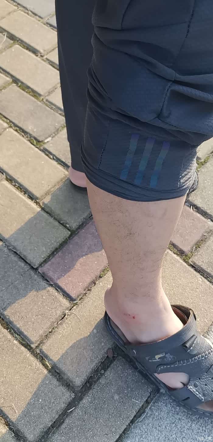 ***股先着地,脚被擦破了,涂了碘伏.