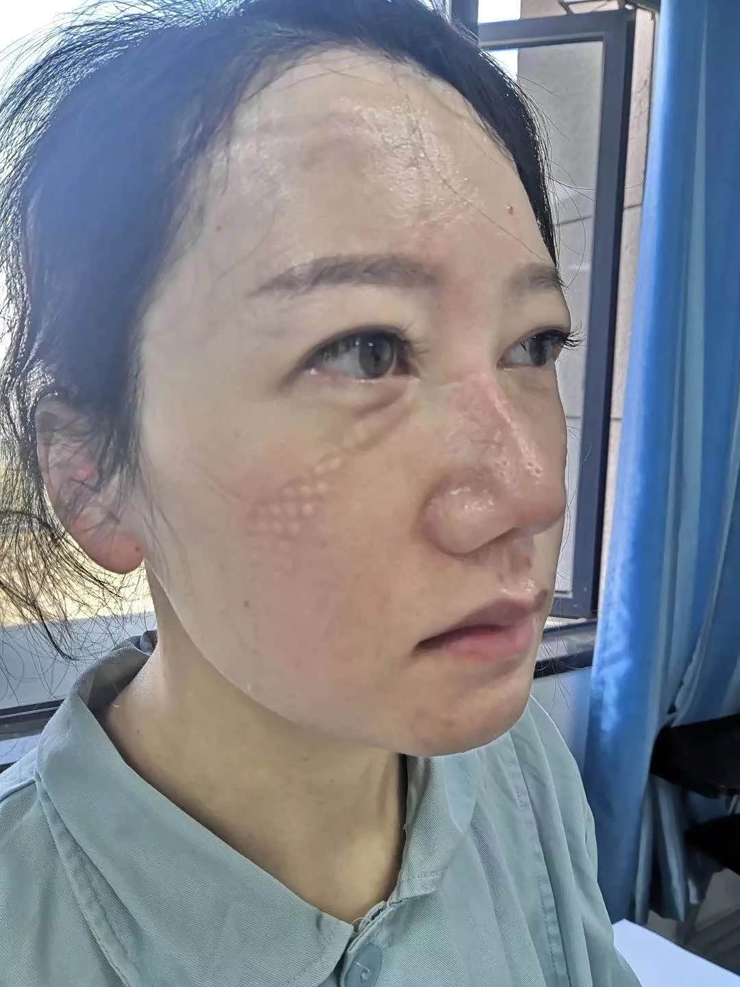 摘下口罩的白衣天使们,真的令人心疼啊!向他们致敬!