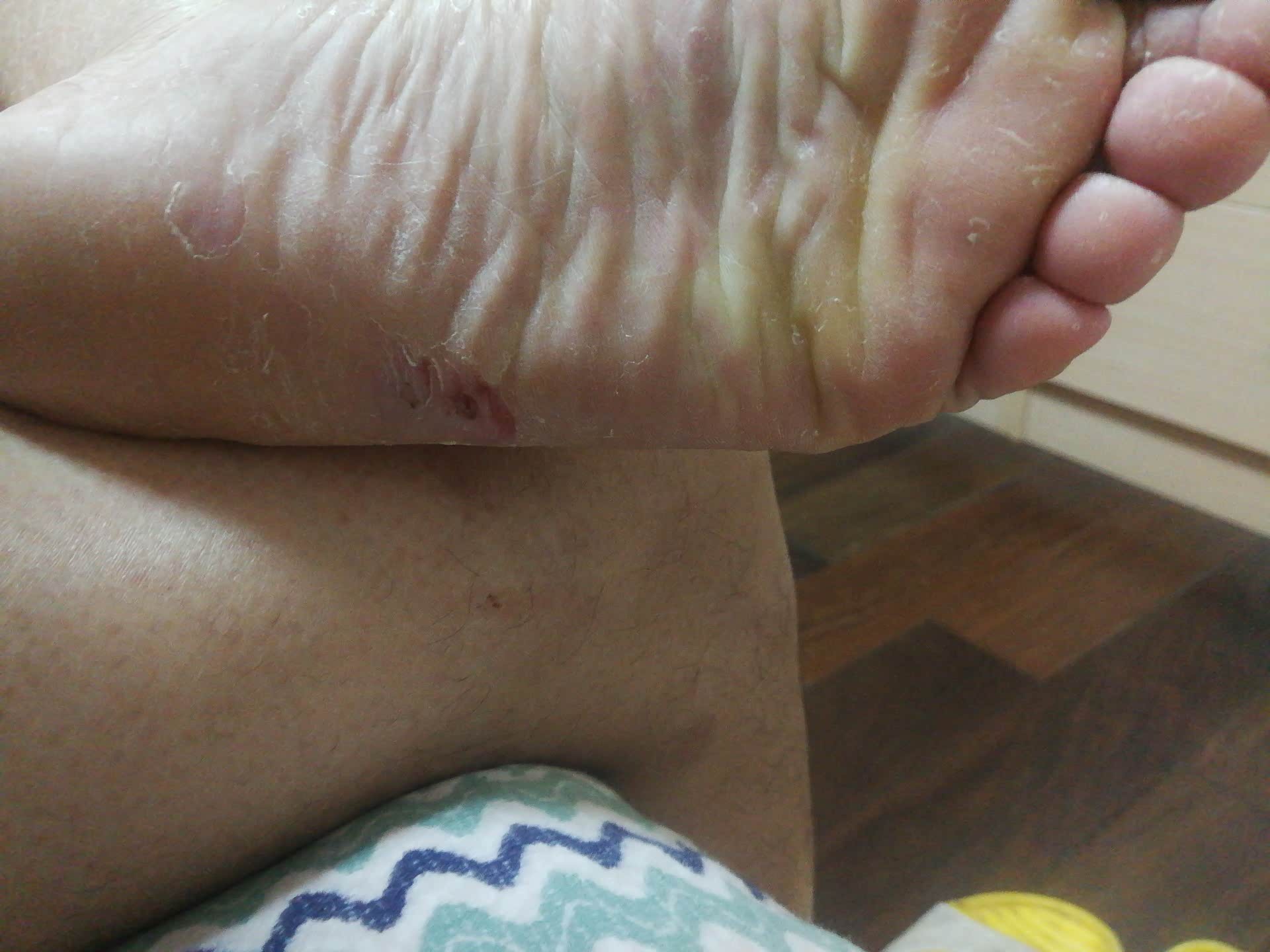 掰脚皮是不是一种病