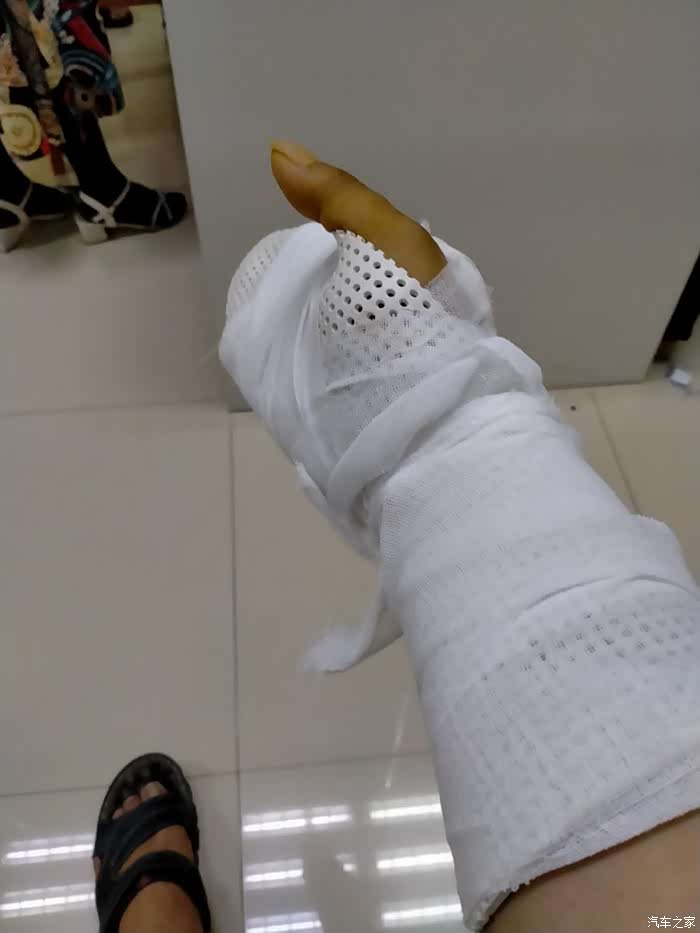 手背被割伤致一手背肌腱断裂
