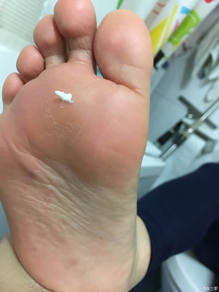 关于脚气的问题