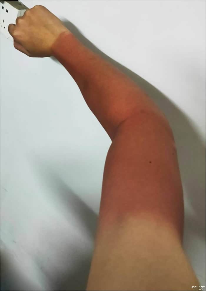 致敬我晒伤的手臂