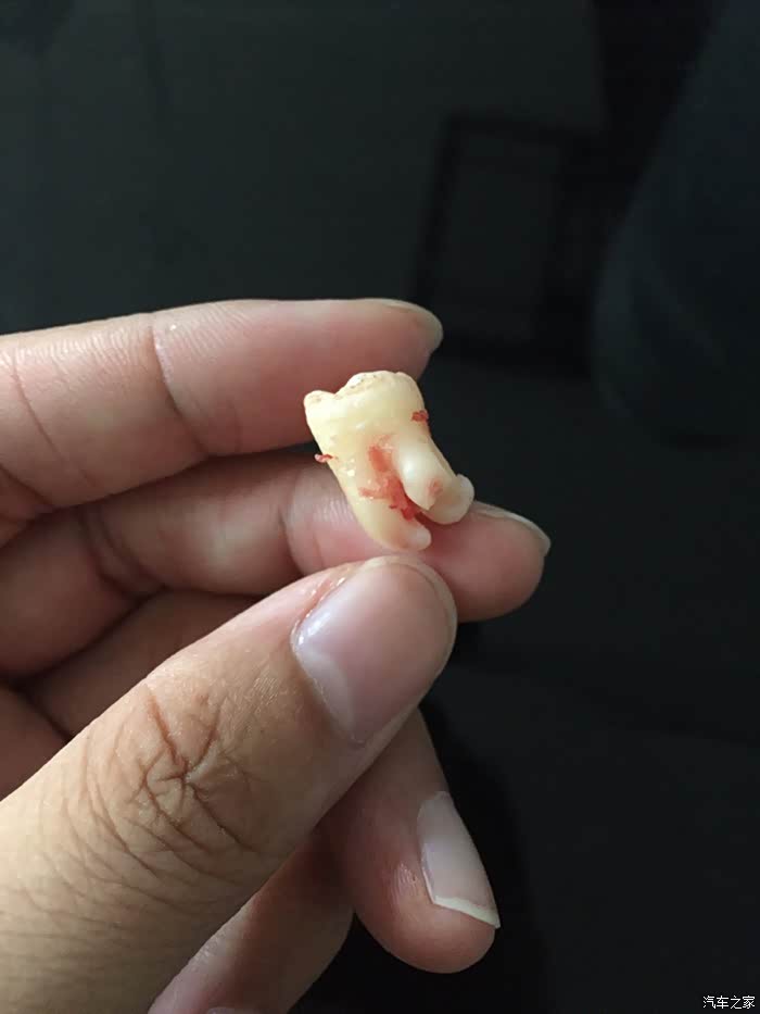 另外今天拔个智齿带勾智齿供家欣赏